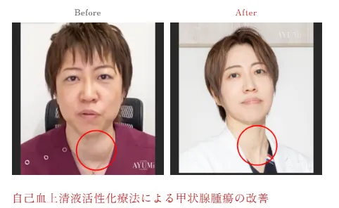 案例1：自体血清活性化疗法改善甲状腺肿瘤