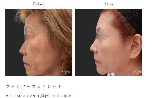 案例2：自体血清活性化疗法改善脱发