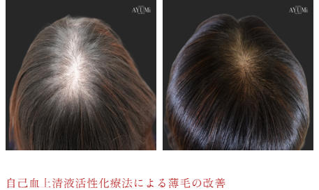 案例2：自体血清活性化疗法改善脱发